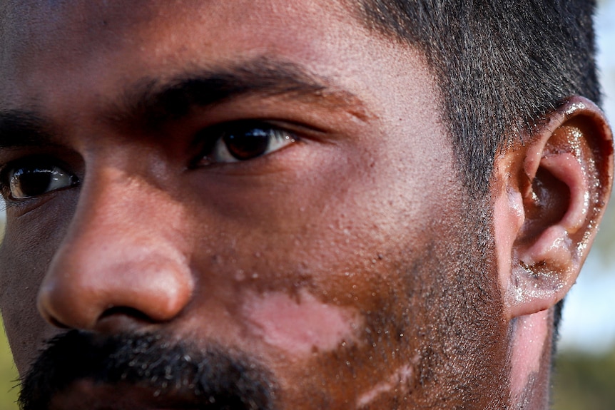 Close up of side of man's face with ear visibly affected by burns.