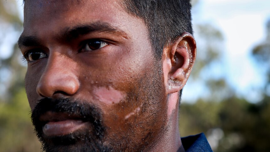 Close up of side of man's face with ear visibly affected by burns.