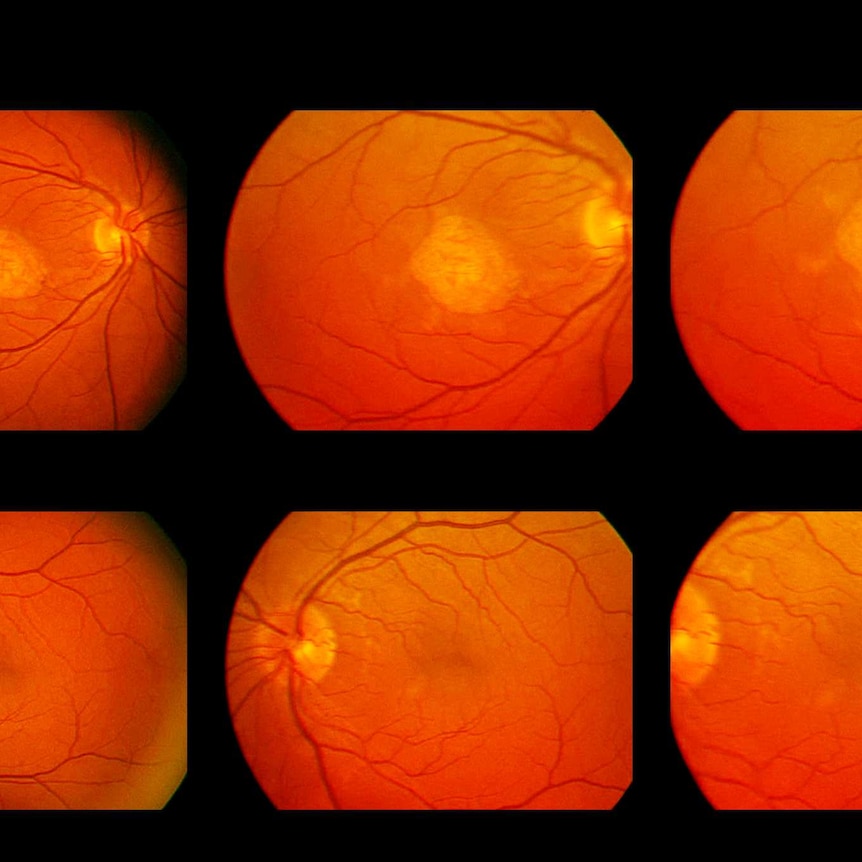Scan of an eye showing macular degeneration