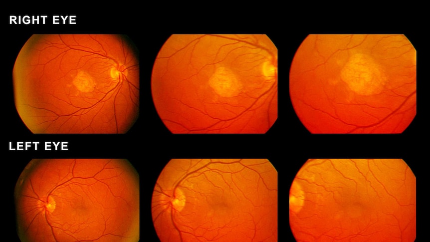 Scan of an eye showing macular degeneration