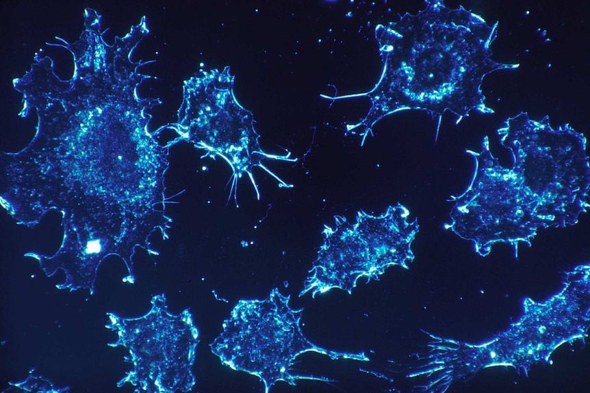 Stained blue cancer cells under the microscope