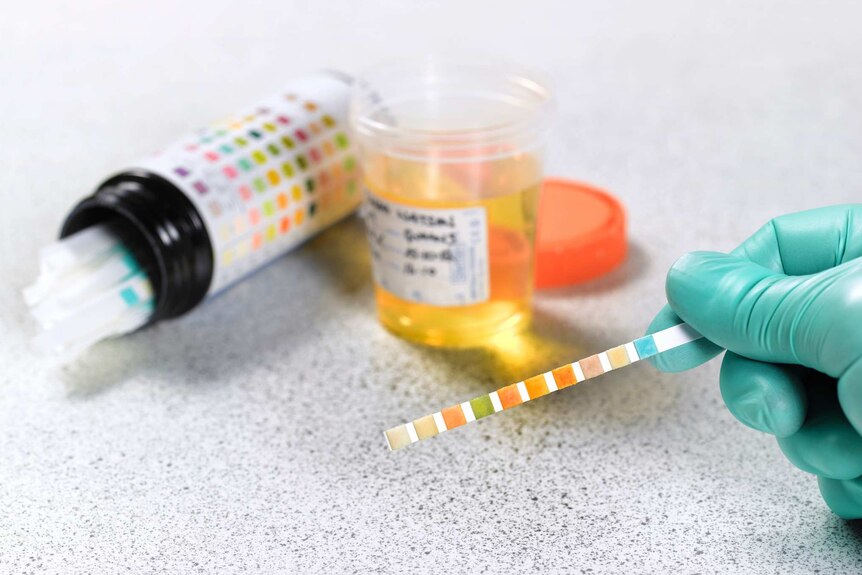 A gloved hand holds a pH test stick, there is an open urine sample jar in the background and a container of dipstick tests.