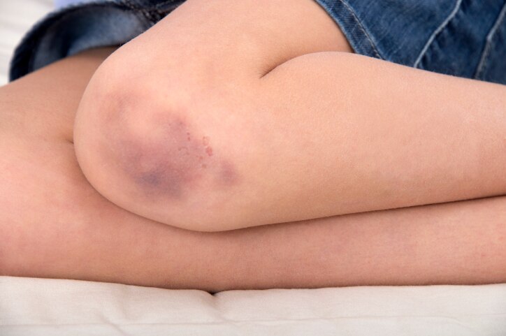 Pair women's knees, one knee with bruise