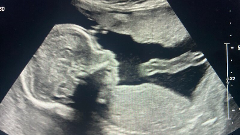 a baby scan.