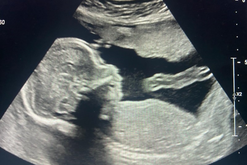 a baby scan.