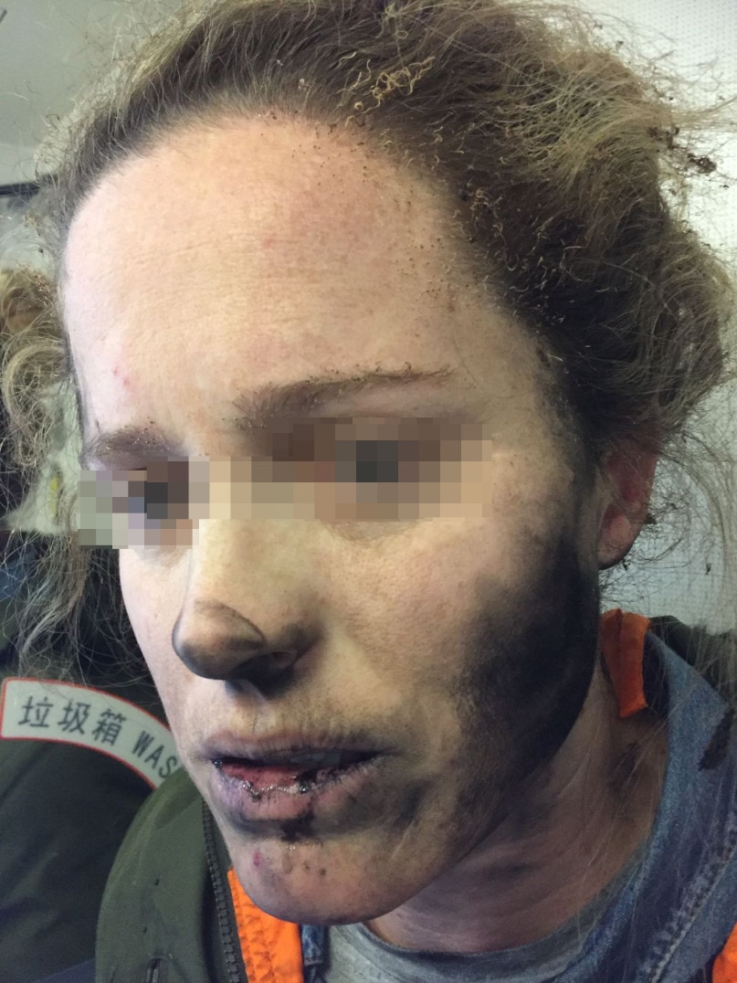 Burns caused to a woman's face after her headphones exploded on a flight.