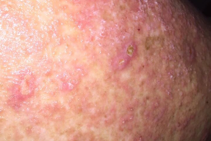 A skin condition, believed to be scabies