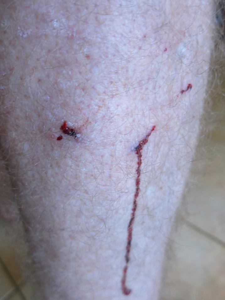 A the back of a bloodied leg with two small puncture marks.