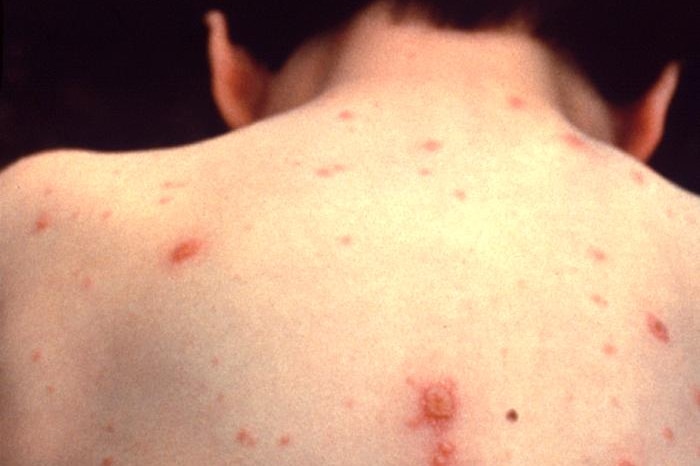 A child suffering from chickenpox, as seen from behind.