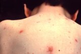 A child with chickenpox's pock-marked back.
