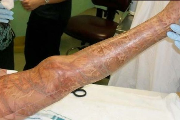 A survivor's leg covered in scars from a box jellyfish sting