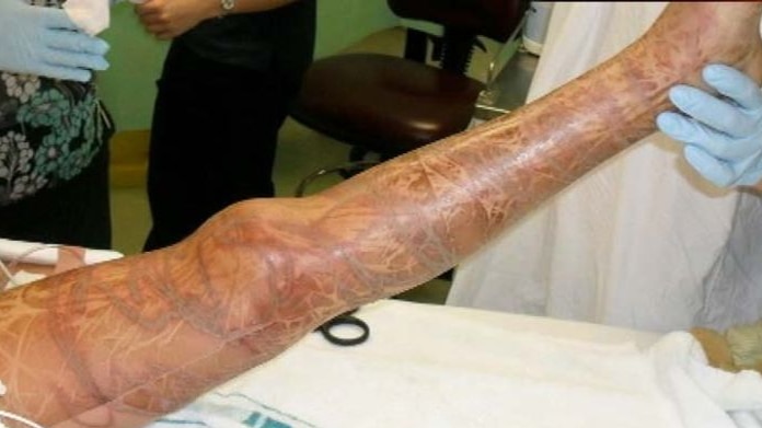 A survivor's leg covered in scars from a box jellyfish sting