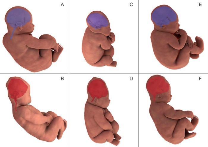 Six graphics that show the shape of a baby's brain as it is elongated and returned during labour