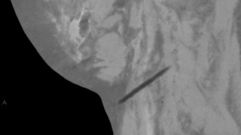 An X-ray of stabbing victim Michael.