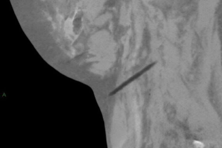 An X-ray of stabbing victim Michael.