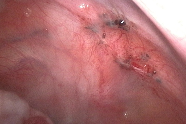 Laparoscopic image of endometriosis on the peritoneum