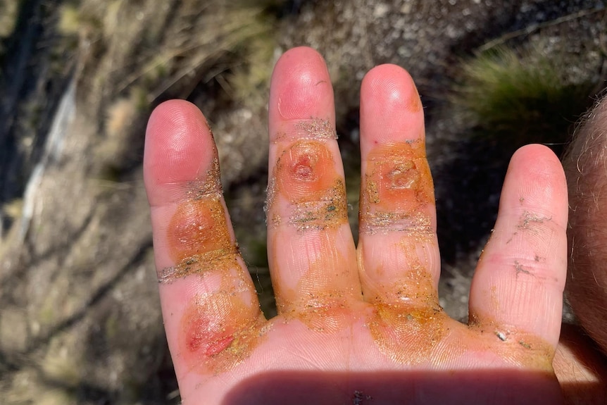 A hand with bloodied blisters on the fingers.