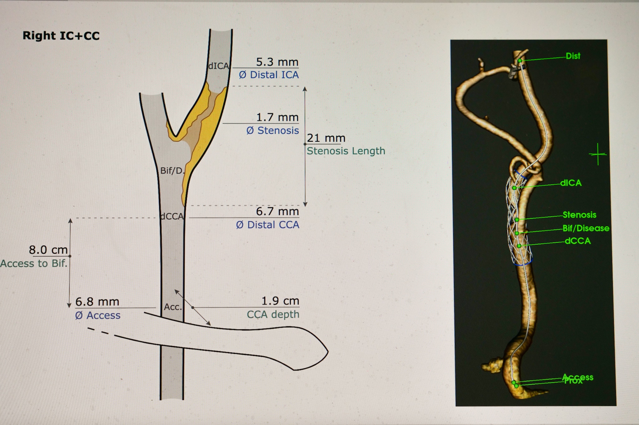 A computer screen with diagram of blocked artery