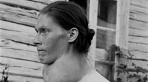 An unidentified woman from Europe with goitre, from iodine deficiency.
