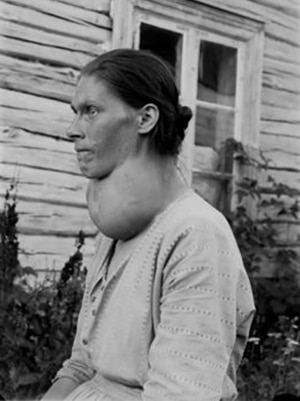 An unidentified woman from Europe with goitre, from iodine deficiency.