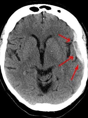 Image of a scan of a someone having suffered a brain bleed.