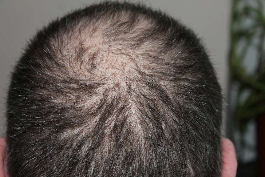 Baldness Gene: How Genetics Influence Hair Loss