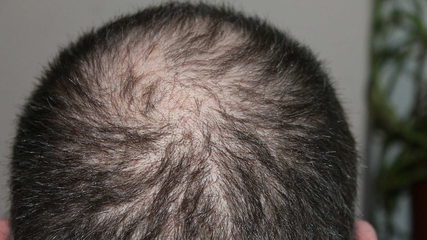 Hair loss: Why does it happen, and can it be stopped? - ABC News
