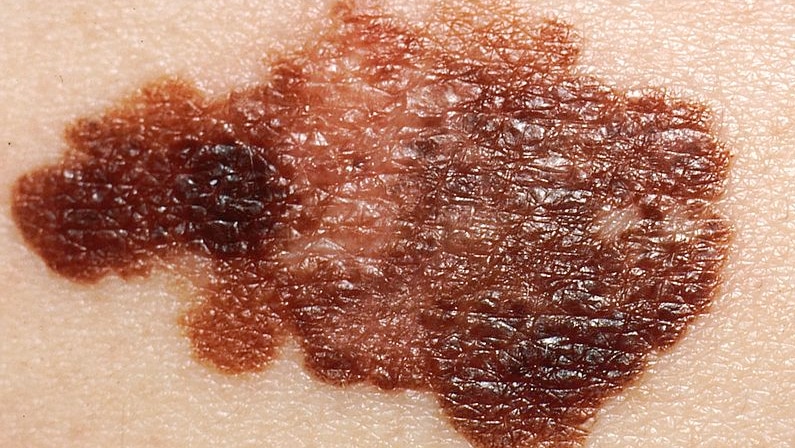 Melanoma on a patient's skin