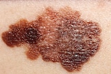 Melanoma on a patient's skin