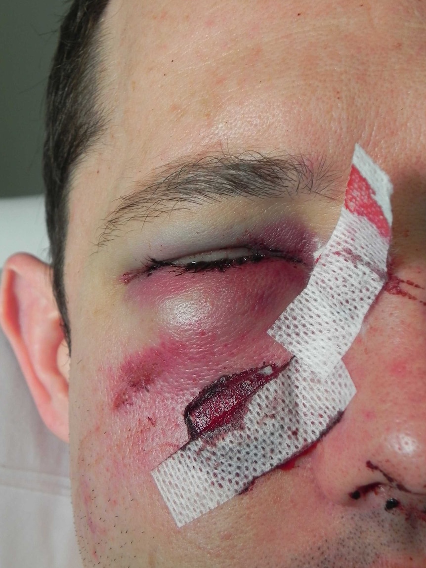 A man with a cut face and a black eye.