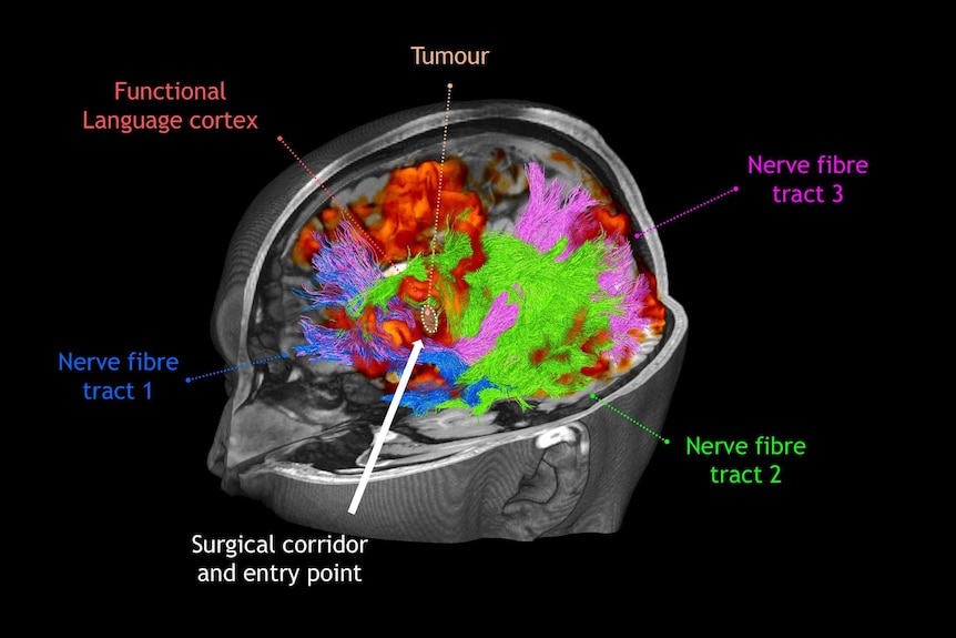 MRI scan with labels showing a brain lesion