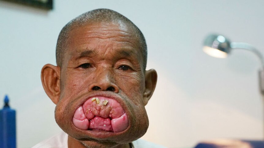 Close-up shot of man facing camera showing deformity in his mouth.