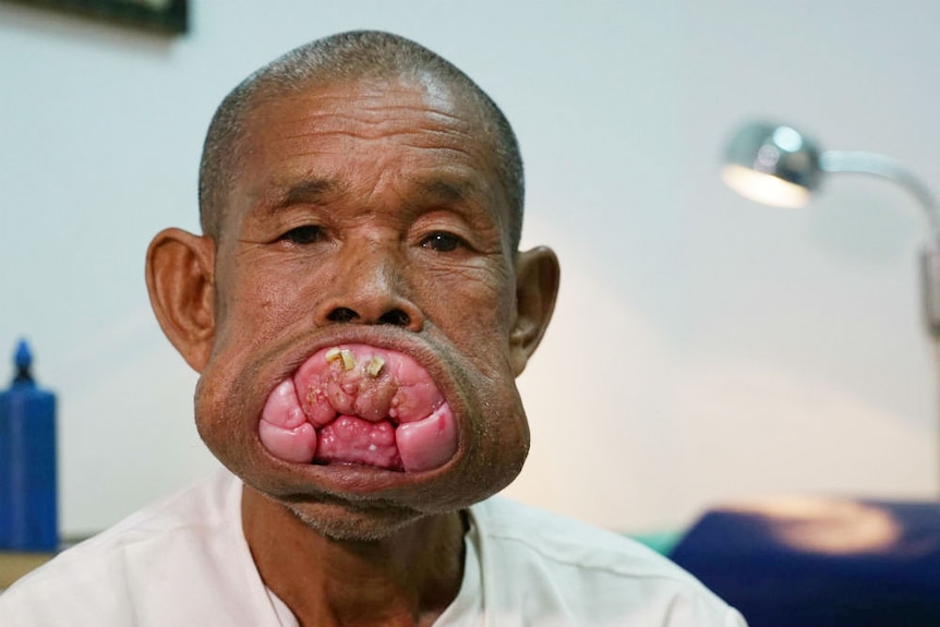 Close-up shot of man facing camera showing deformity in his mouth.