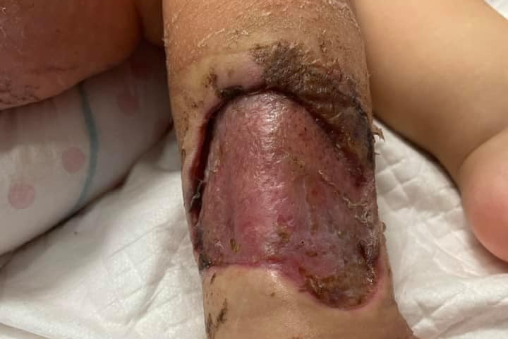 a wound on the leg og a two year old after 8 surgeries