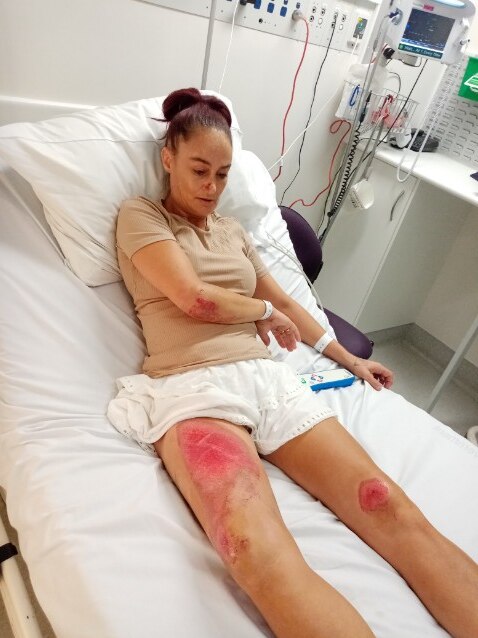 A woman with multiple skin abrasions lies in a hospital bed. 