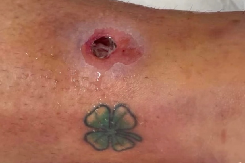 A pussy and leaking infection on an ankle next to a four-leafed clover tattoo. 