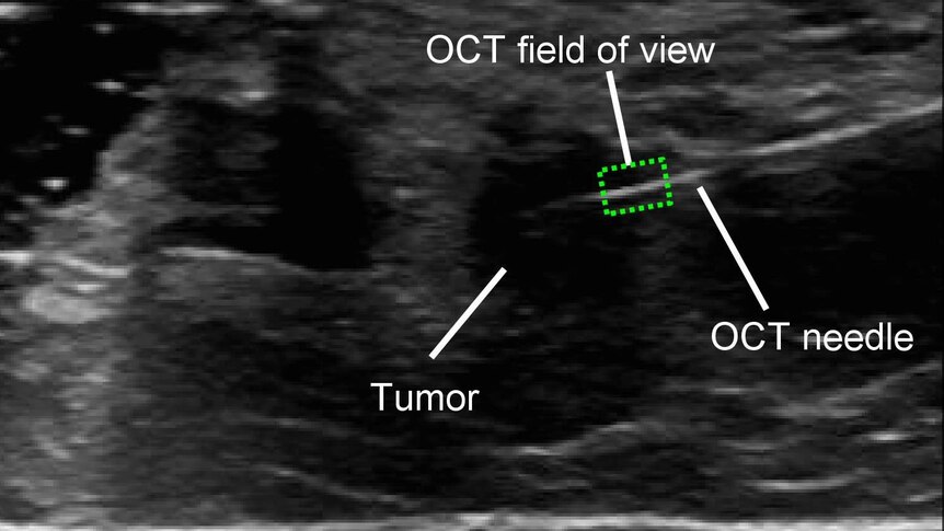 An ultrasound image of the microscope inserted into human breast tissue.