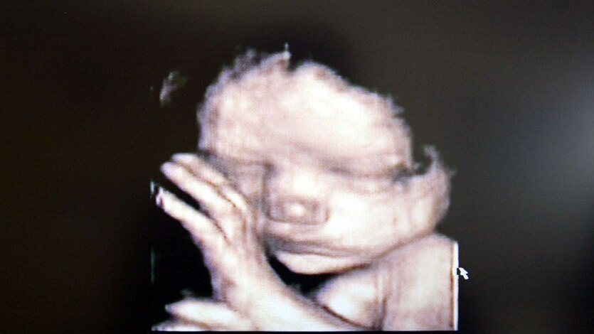 A 3D ultrasound showing a foetus inside the womb