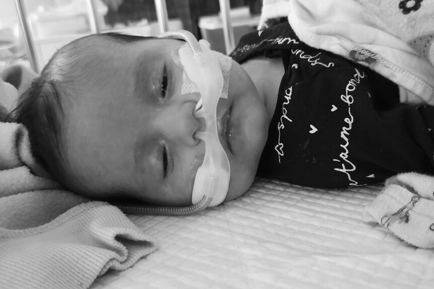 A baby asleep with an oxygen hose taped to her nose