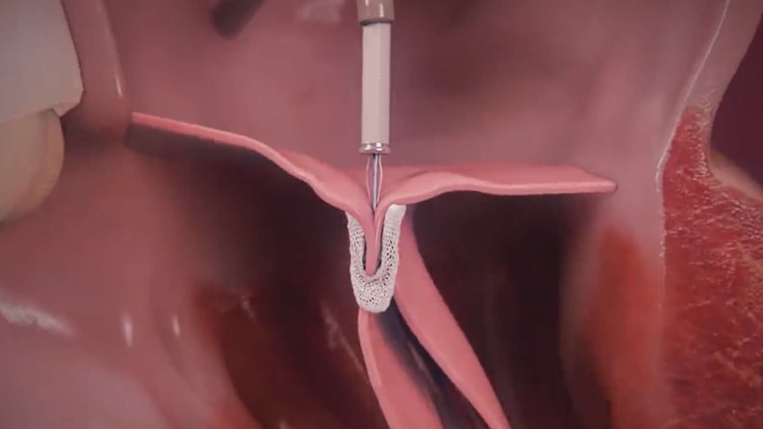 A graphic representation of the MitraClip device repairing a mitral valve.