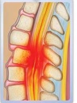 A drawing of a spinal injury