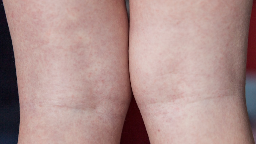 A light rash on the back of  a childs legs. 