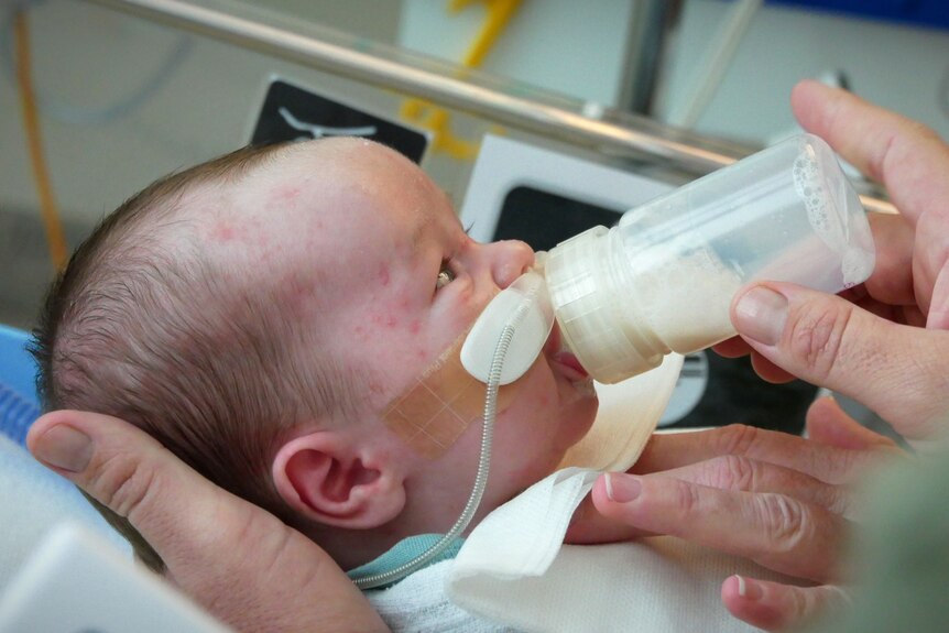 A baby with a breathing tube in his nose drinks milk from a bottle