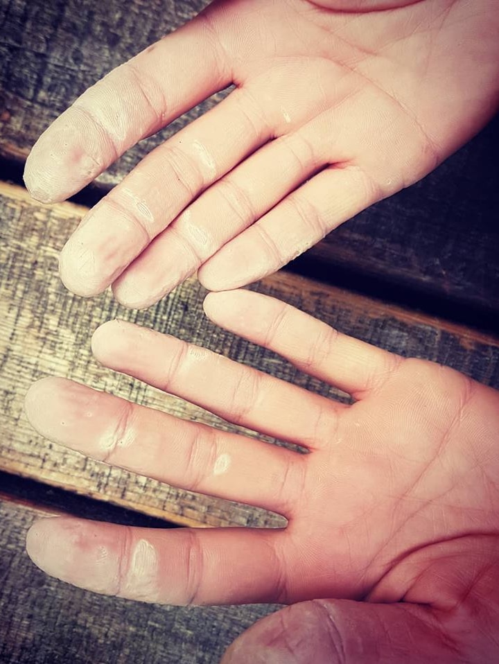 One of the kayakers showing the palms of her hands covered in blisters and peeling skin