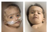 Conjoined twins, Krishna and Trishna, will be separated in about six or eight months time.