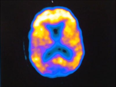 The controversy over a 'breakthrough' dementia drug