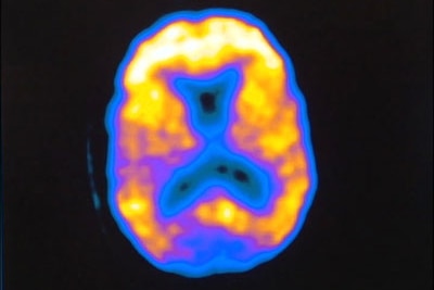 Brain scan of someone with Alzheimer's disease