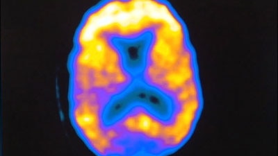 Early warning: The scan can detect the proteins that cause Alzheimer's.
