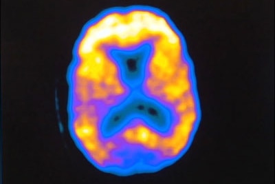 Memory boost: The drug stimulates the proteins needed for long-term memory.