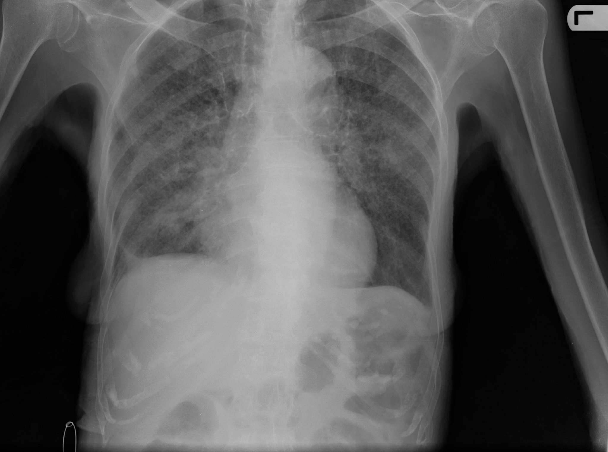 A chest X-ray showing lung damage caused by tuberculosis.